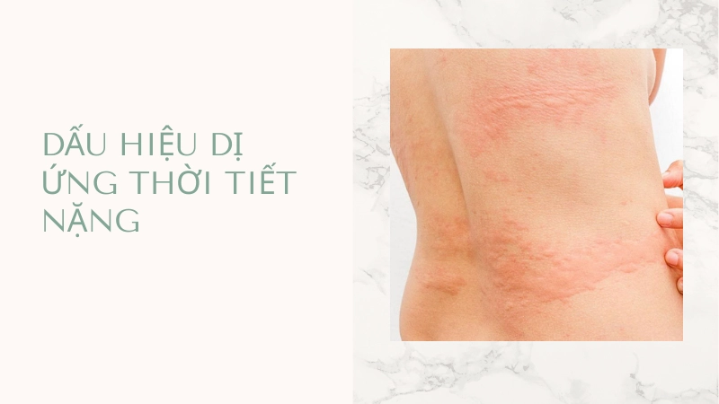 Biểu hiện nổi mề đay cấp tính cần được xử lý y tế kịp thời