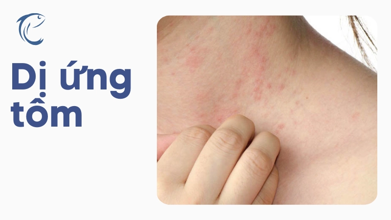 Dị ứng tôm và dấu hiệu cần xử lý kịp thời